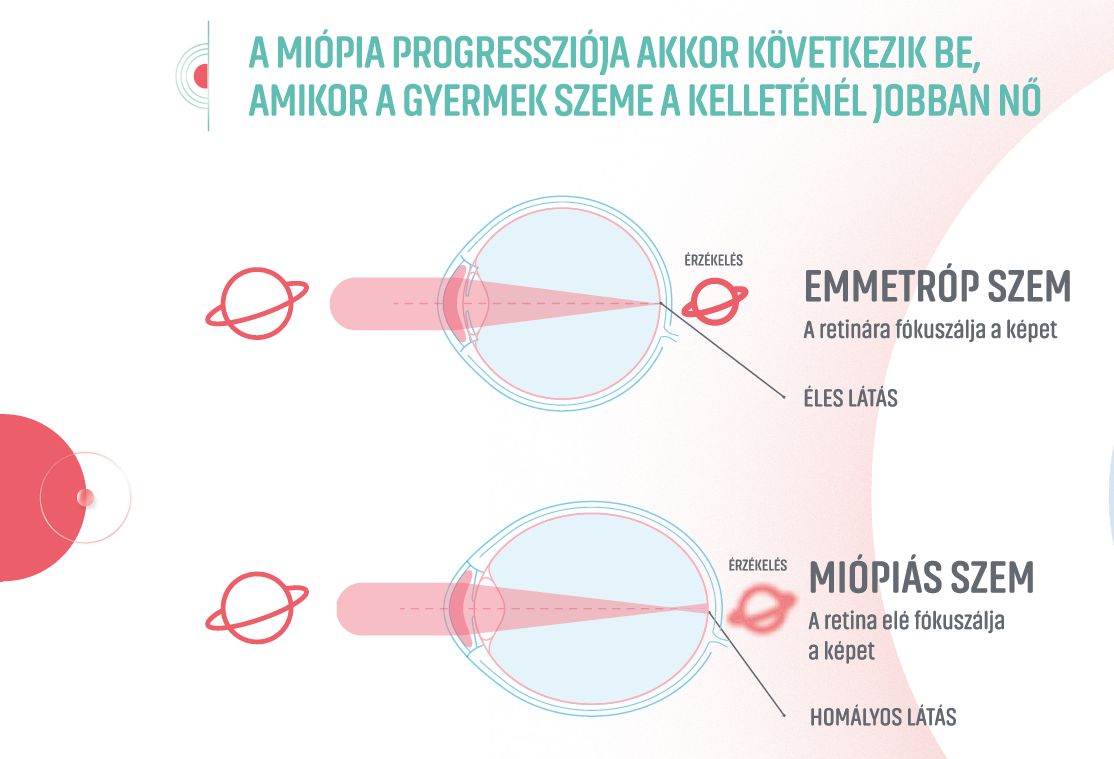 Essilor Stellest új fejlesztésű szemüveglencse a rövidlátás lassítására 2