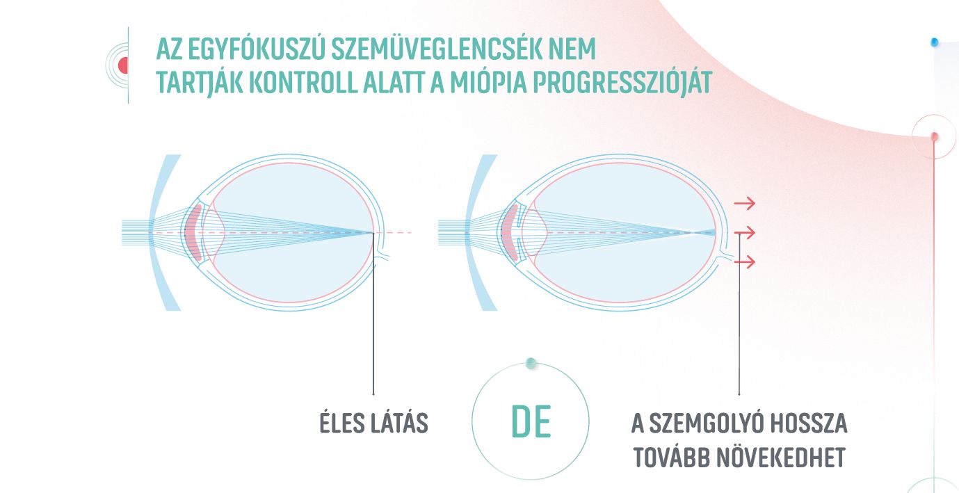 Essilor Stellest új fejlesztésű szemüveglencse a rövidlátás lassítására 4