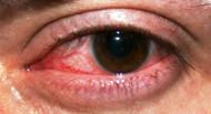 A kontaktlencsék túlhordása súlyos szemészeti tüneteket okozhat!